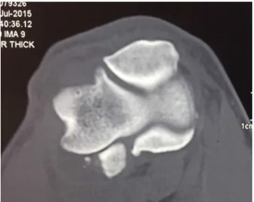 Fig. 5 – Patient on the fifth postoperative day. Complete metacarpophalangeal joint extension is observed.