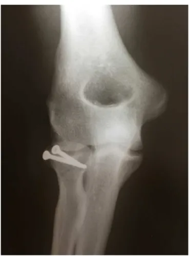Fig. 8 – Postoperative elbow AP radiograph showing the fixation of the radial head fracture with two micro fragment screws.
