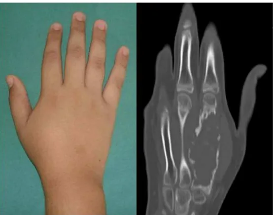 Fig. 1 – Physical and radiological examination showing the tumor on the second metacarpal.