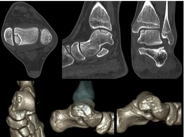 Fig. 1 – Axial computed tomography allows for the identification, measurement, and accurate classification of osteochondral lesions of the talus
