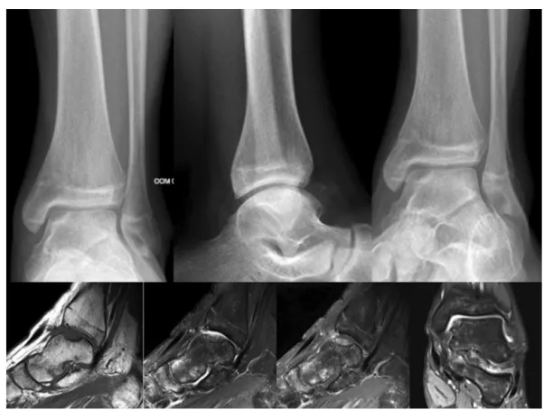 Fig. 2 – X-rays of the ankle and magnetic resonance imaging of a patient who underwent arthroscopic treatment with debridement and microfractures.