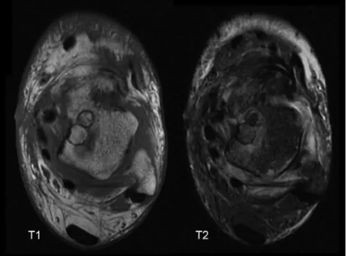 Fig. 5 – MRI scans obtained six months after autologous osteochondral graft.