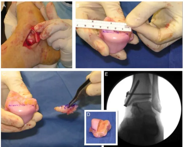 Fig. 6 – Osteochondral homograft used for the treatment of extensive medial talar shoulder injury (The authors thank Dr.