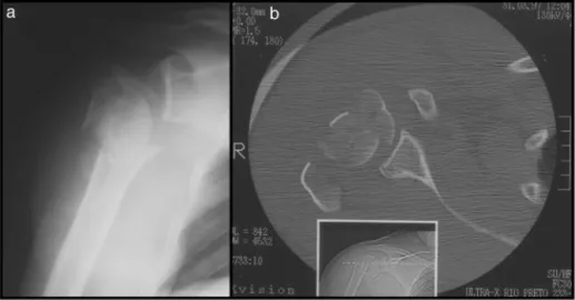 Fig. 1 – Case 4 – epiphyseal fracture of the proximal third of the right humerus into four parts: frontal radiograph (a) and computed axial tomography (b).