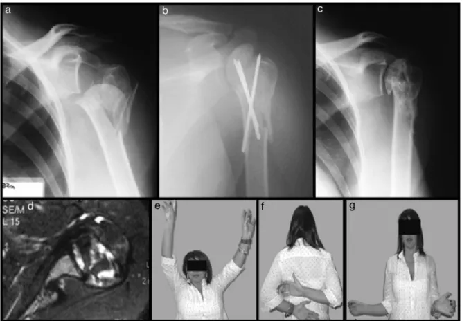 Fig. 3 – Case 12 – fracture of the proximal third of the left humerus in four parts, impacted in valgus with epiphyseal line: