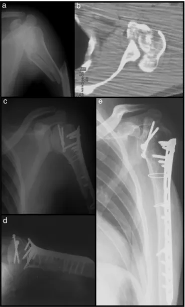 Fig. 4 – Case 15 – complex fracture of the left proximal humerus with traumatic brachial plexus injury: frontal radiograph of the shoulder (a) and axial computed tomography image (b) showing the epiphyseal fracture.