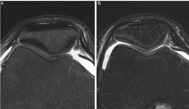 Fig. 1 – Axial T2WI at the patellofemoral joint. Initial imaging (A) and imaging at the one-year follow-up (B) demonstrating a similar cartilage signals.