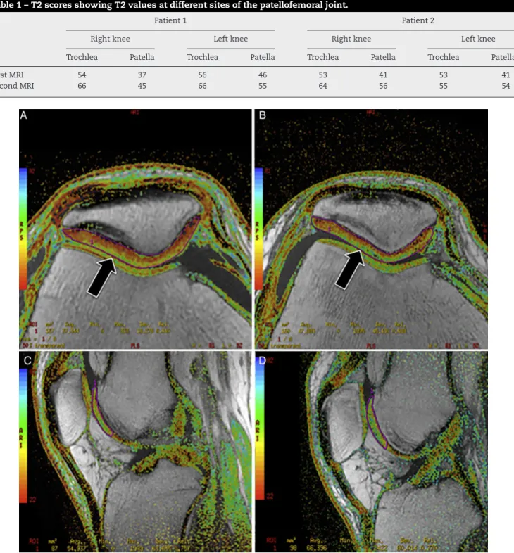 Fig. 2 – Axial (A and B) and sagittal (C and D) T2 mapping images at the patellofemoral joint
