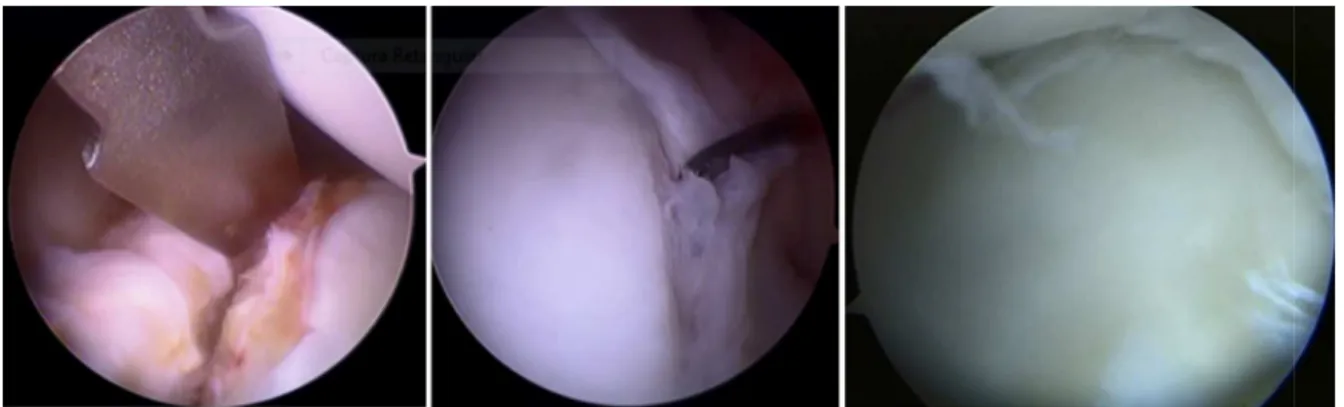 Fig. 2 – Circumferential labral lesion.