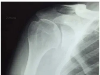 Fig. 4 – Glenohumeral arthritis, Samilson grade 1.