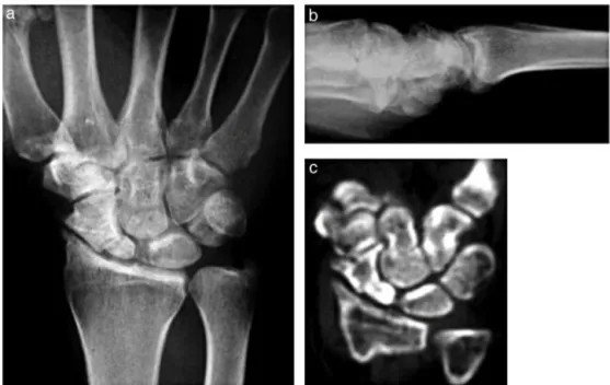 Fig. 1 – Preoperative tests: (a) wrist X-ray in posteroanterior (PA); (b) X-ray in profile (P); (c) coronal tomographic slice of this wrist.