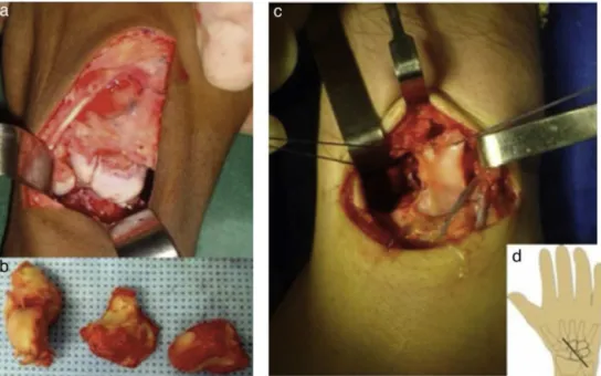 Fig. 2 – Intraoperative aspect of resection of the proximal carpal row. (a) Dorsal access to the wrist; (b) scaphoid, lunate, and triquetrum removed; (c) making of the flap in the wrist dorsal capsule, which was used to coat the head of the capitate; (d) p