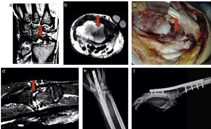 Fig. 4 – Additional preoperative exams and intraoperative aspects (complication) of the second procedure to correct radio-capitate osteoarthritis