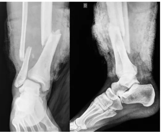 Fig. 1 – Image of the open diaphyseal fracture of the leg with no evidence of injury in the ankle joint.