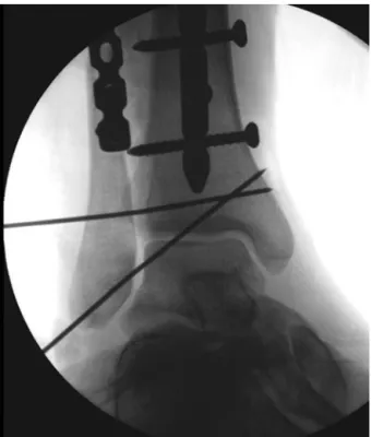 Fig. 4 – Intraoperative clinical picture showing torn articular capsule and anterior tibiofibular ligament.
