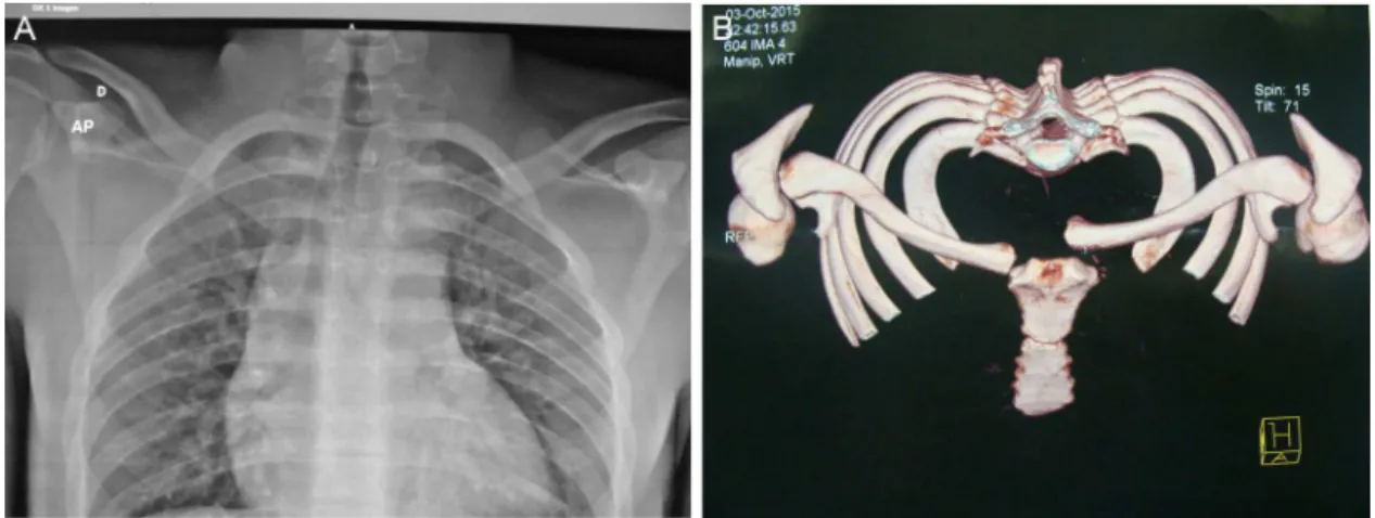 Fig. 1 – (A) Radiography showing the sternoclavicular dislocation to the left; (B) computed tomography 3-D reconstruction demonstrating the dislocation to the left.