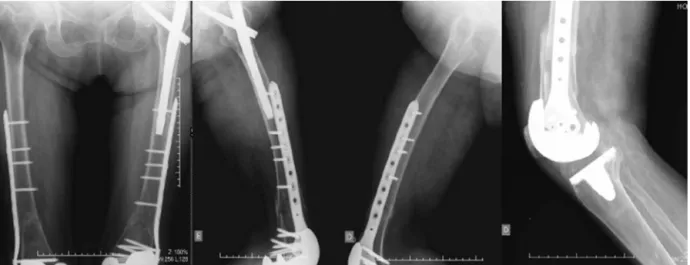 Fig. 4 – Radiographs after three months follow-up.