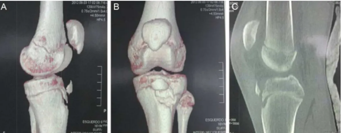Fig. 2 – Computed tomography of the left knee, 3D reconstruction in profile (A) and anteroposterior view (B) showing avulsion of ATT and sagittal view (C) with type 1 injury according to the Watson–Jones classification.