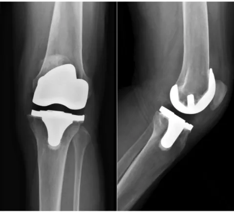 Fig. 4 – Radiographs of the last follow-up evaluation: anteroposterior and lateral views of the left knee.