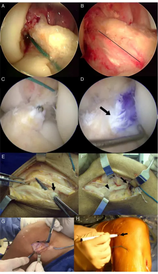 Fig. 3 – ACLR involving current concepts of remnant tissue preservation and extra-articular reinforcement with iliotibial tract band (monoloop) and reconstruction of the anterolateral ligament