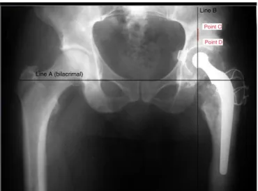 Fig. 1 – Hip X-ray in anteroposterior incidence showing measurement of the size of bone defect in millimeters in the vertical plane; this measurement corresponds to the greatest distance between the edge of the acetabular lesion (point C) and the acetabula