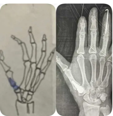 Figure 1 – Image to compare the pre-operative planning and radiograph aspects post operative.