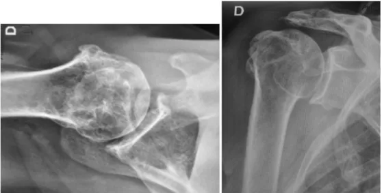 Fig. 1 – X-rays in anteroposterior and axillary incidence of a shoulder with rotator cuff arthropathy.