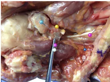 Fig. 3 – Marking of shoulder superolateral structures with the clavicle posteriorly dislocated