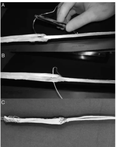 Fig. 1 – (A) Tensioned triple semitendinosus graft and double gracilis graft; intertwined, ready for suturing