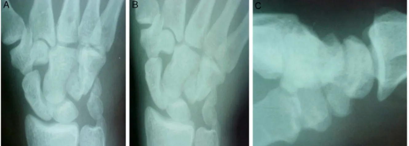 Fig. 1 – Right wrist X-rays in true anteroposterior (A), ulnar deviation (B), and profile incidences (C), showing pyramidal fracture and instability of the hamate.