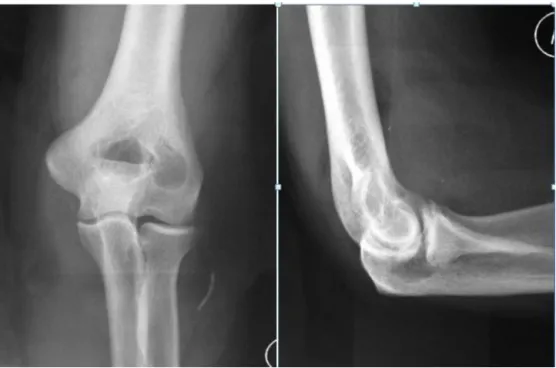 Fig. 1 – Elbow radiograph in anteroposterior and profile, with no alterations.