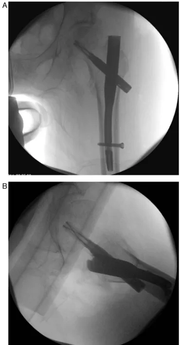 Fig. 1 – Transthrocantheric AO 31-A1 fracture on the left.