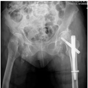 Fig. 4 – Pelvic migration of the helical blade on the second month postoperatively.