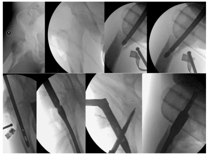 Fig. 1 – Reduction of the subtrochanteric fracture with cephalomedullary nail.