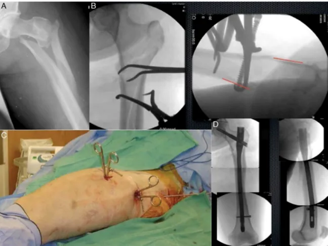 Fig. 3 illustrates the treatment of a complex sub- sub-trochanteric fracture reduced with percutaneous clamps and fixed with a long cephalomedullary nail.