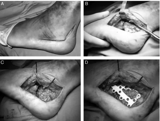 Fig. 1 – Wide lateral approach as described by Seligson (A); reduction of the fracture by direct visualization with periosteum elevator (B); temporary fixation of the reduction with Kirschner 1.6 wire (C); internal fixation with 3.5-mm calcaneus plate (D).