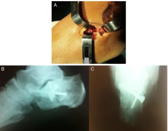 Fig. 3 – Example of calcaneal fracture treated with minimal incision lateral approach and fixation with pins and screws