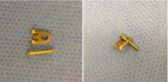 Fig. 3 – Pre-assembled plate for the treatment of mallet finger.