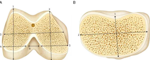 Fig. 1 – Intraoperative measurement (A) right distal femur: 1 – height of the lateral condyle; 2 – height of the medial condyle;