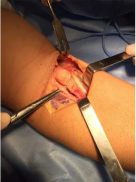 Fig. 11 – Measurement of the diameter of the biceps tendon stump.