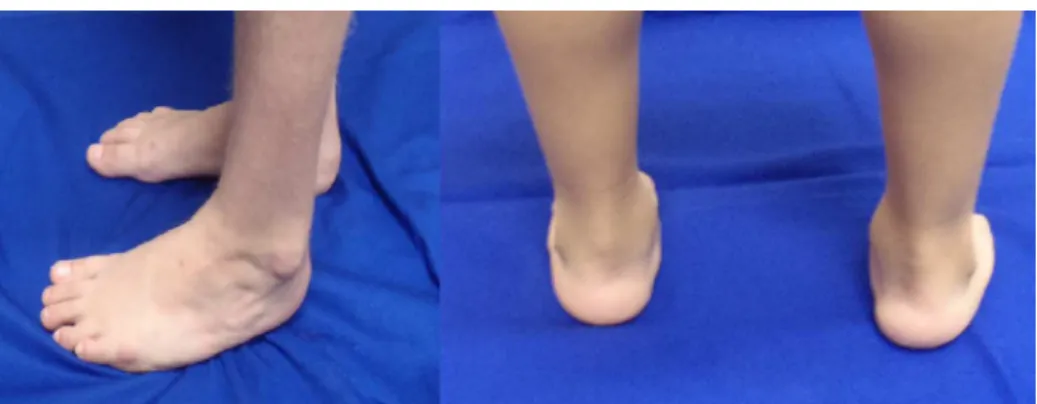 Fig. 4 – Seven-year-old patient, five years after Achilles tenotomy.