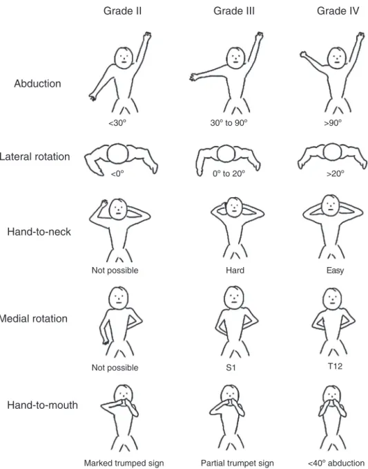 Fig. 1 – Schematic representation of the modified Mallet classification 28 to assess shoulder function in patients with OBPP.