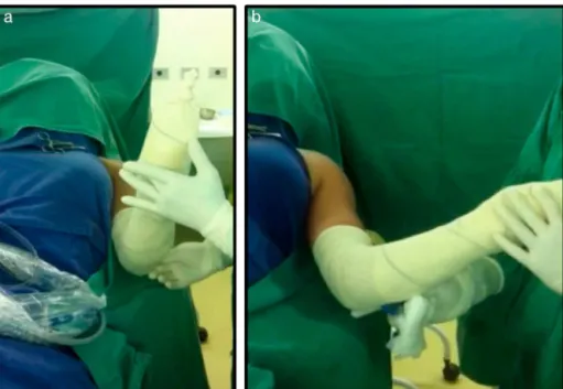 Fig. 2 – Case 3. Passive lateral rotation of the left shoulder before (a) and after (b) the arthroscopic procedure.