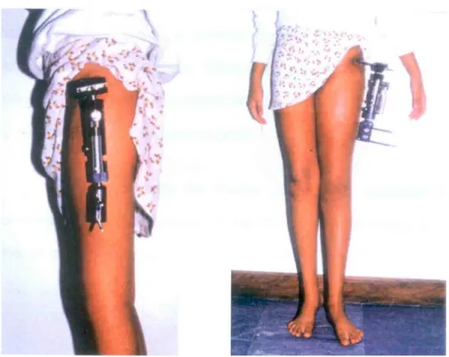 Fig. 4 – Photograph of the ideal positioning of monolateral external fixator (Impolfix ® , Impol, São Paulo, Brazil).