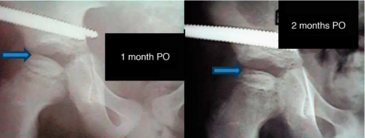 Fig. 5 – Male patient, 7 years and 4 months, Catterall III . Preoperative image.