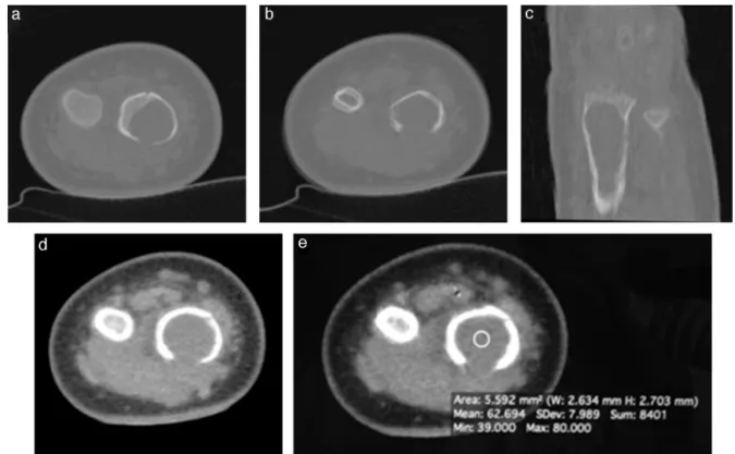 Fig. 2 – CT scan showing the expansile lytic lesion and associated fracture in the axial views (a and b); and the metaphyseal lesion length in the coronal view (c)