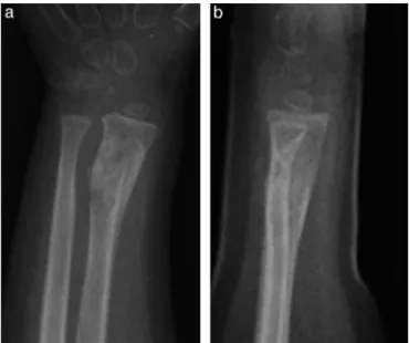 Fig. 4 – Anteroposterior (a) and lateral view (b) radiographs at six postoperative weeks showing fracture healing.