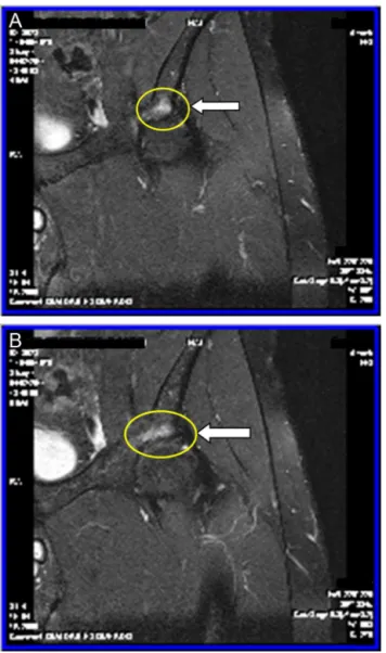 Fig. 2 – Linear hyperintense image on T2 and STIR sequences, surrounded by area of edema with poorly defined limits; acetabular roof stress fracture is suggested.