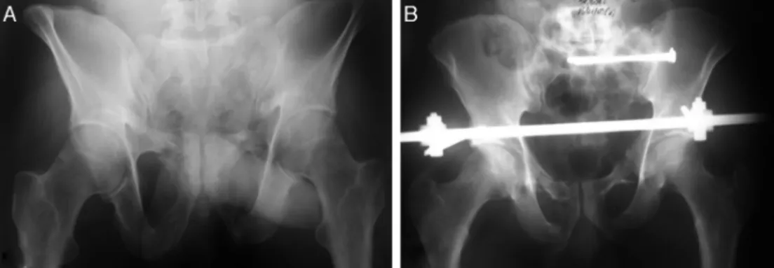 Fig. 1 – (A) Image of the pelvis in outlet view, showing fracturing of the pubic rami and the sacrum on the left