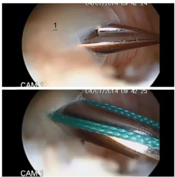 Fig. 1 – Arthroscopic image showing inflammation of the long head of the biceps brachii